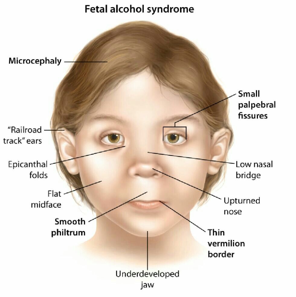 Fetal alcohol syndrome